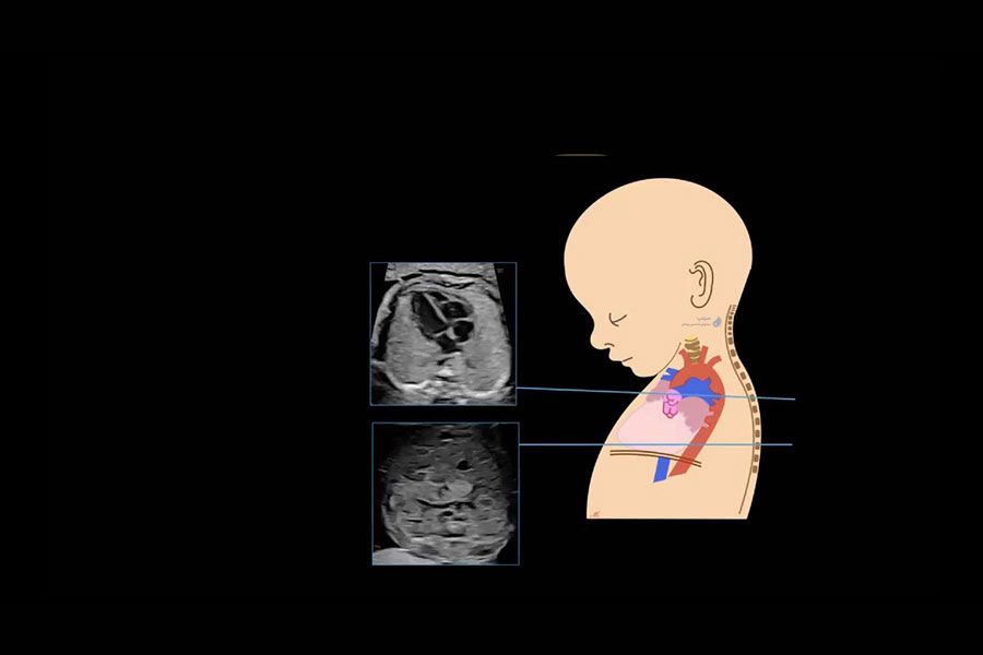 اکوکاردیوگرافی قلب جنین